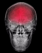 Trauma Brain Injury